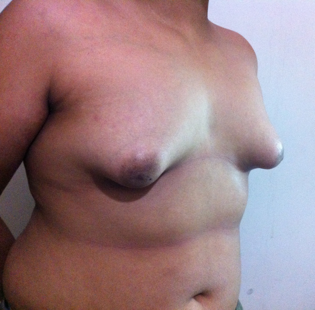 Gynaecomastia or Male Breast Surgery at Vital Clinic India
